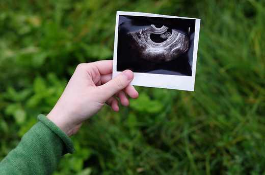 Hand hält einen Ultraschall-Ausdruck vor grünem Hintergrund